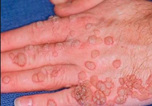 İnsan papilloma viruslarının bəzi növləri xərçəng xəstəliyinə səbəb olur