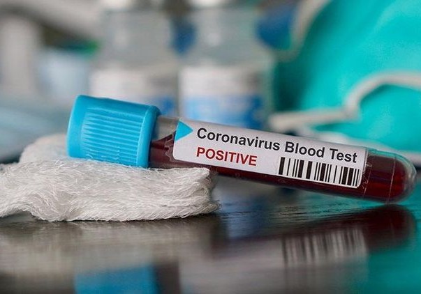 Koronavirus testinin şəxsi istəyə bağlı olunmaması tövsiyə olunur