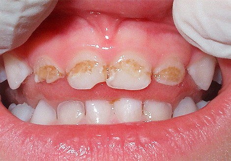 Xarab dişlər hansı xəstəliklərə səbəb ola bilər?