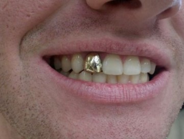 Ağ dişin qızıl dişdən üstünlüyü